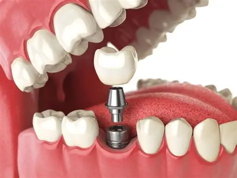 Dental Implants Process